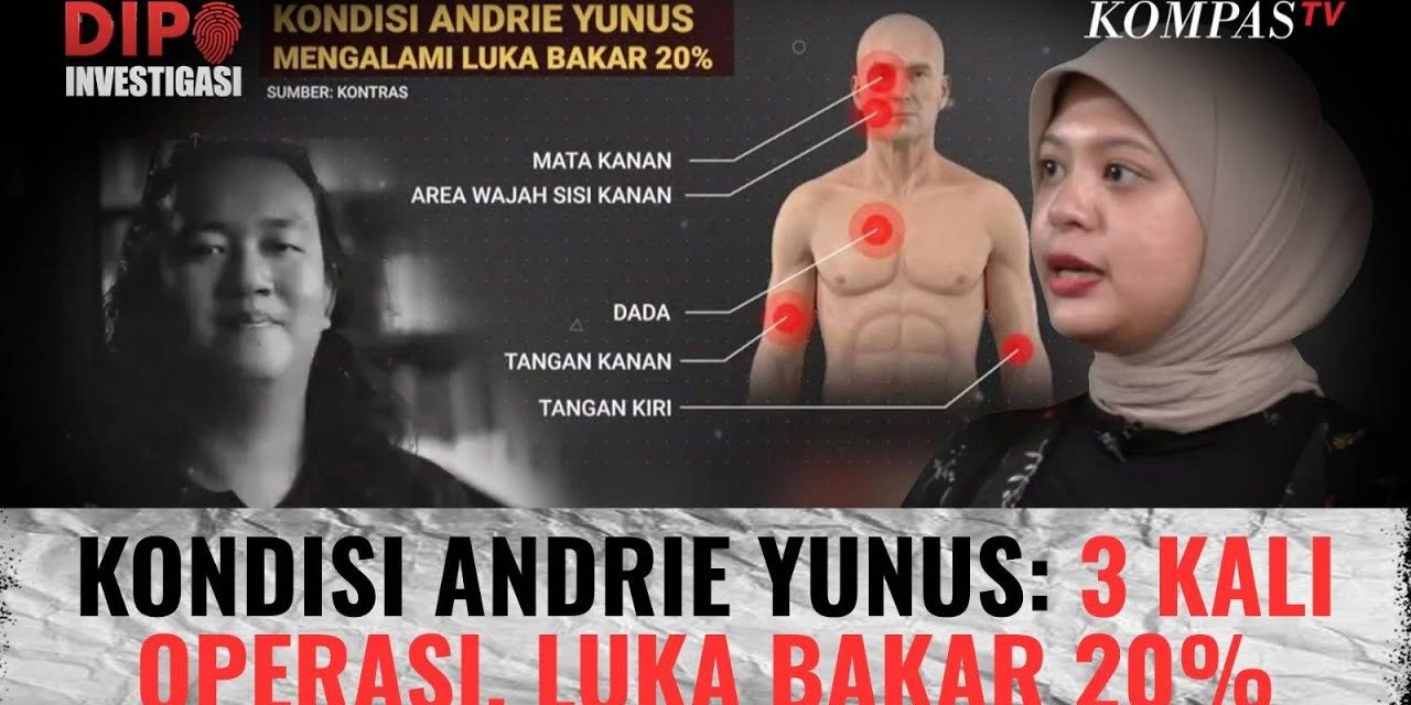 Kisah Andrie Yunus: 3 Pekan Melawan Luka Usai Disiram Air Keras