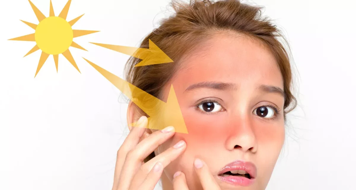 Mencerahkan Kulit Yang Terbakar Sinar Matahari, Yuk Kita Bahas